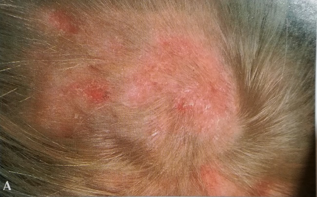 Грибок волосистой части головы типа эктотртикс, вызвынный Microsporum canic.