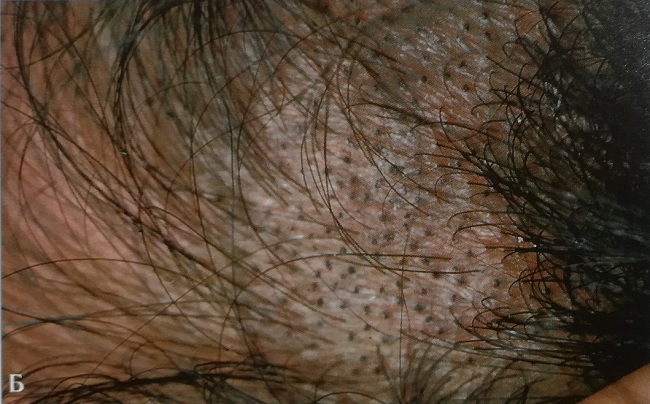 Грибок волосистой части головы типа эктотртикс, вызвынный Microsporum canic.
