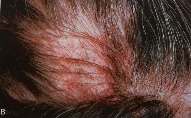 Фавус кожи головы, вызванный Trichophyton schoenleinii.