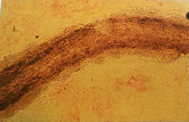 прямая микроскопия волоса, пораженного эктотриксом