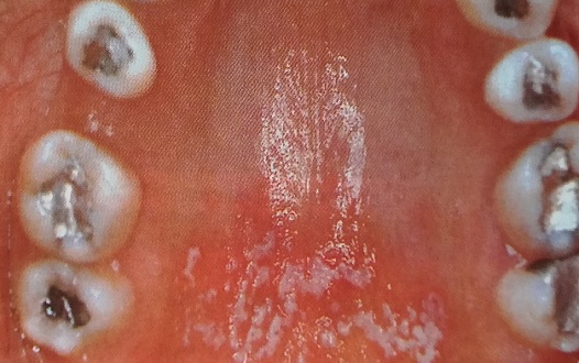 Кандидоз от зубных пломб
